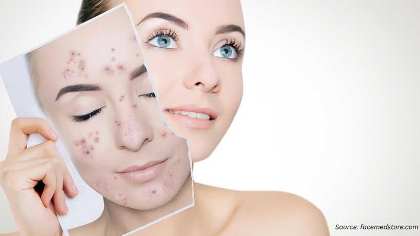 How Clinical Innovation and Digital Dermatology Are Redefining the Future of the Professional Acne Medication Market