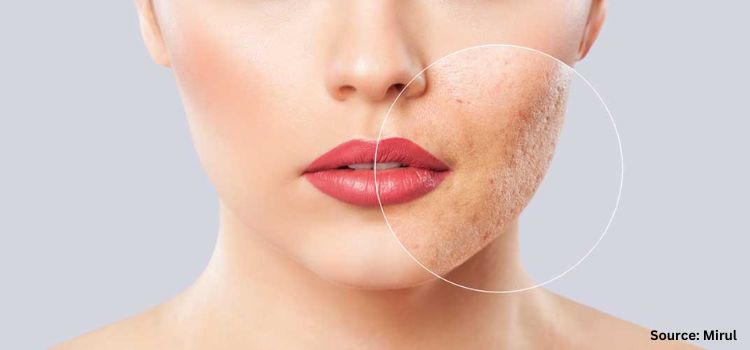 How Acne Medication Delivers Clear Skin Fast