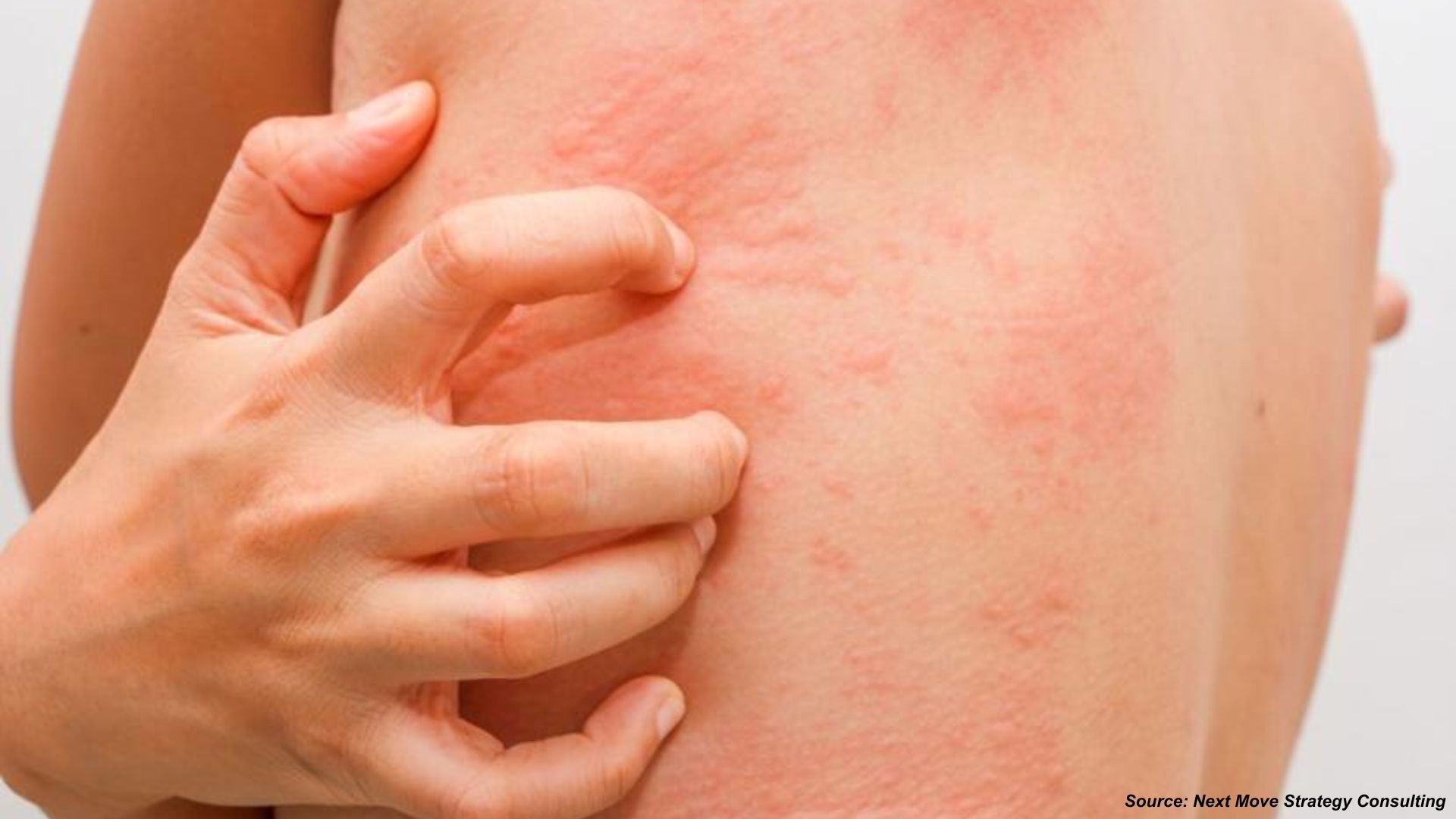 Allergy Treatment Market: Breakthroughs, Biologics...