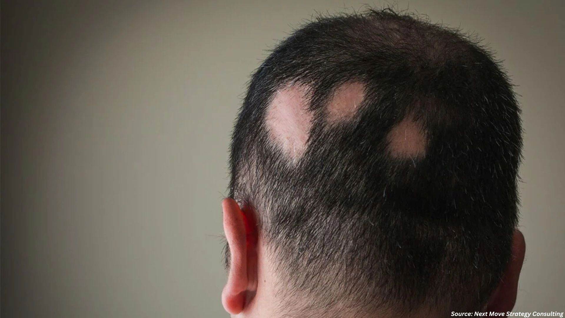 Alopecia Market Gains Momentum with Breakthrough Clinical Data