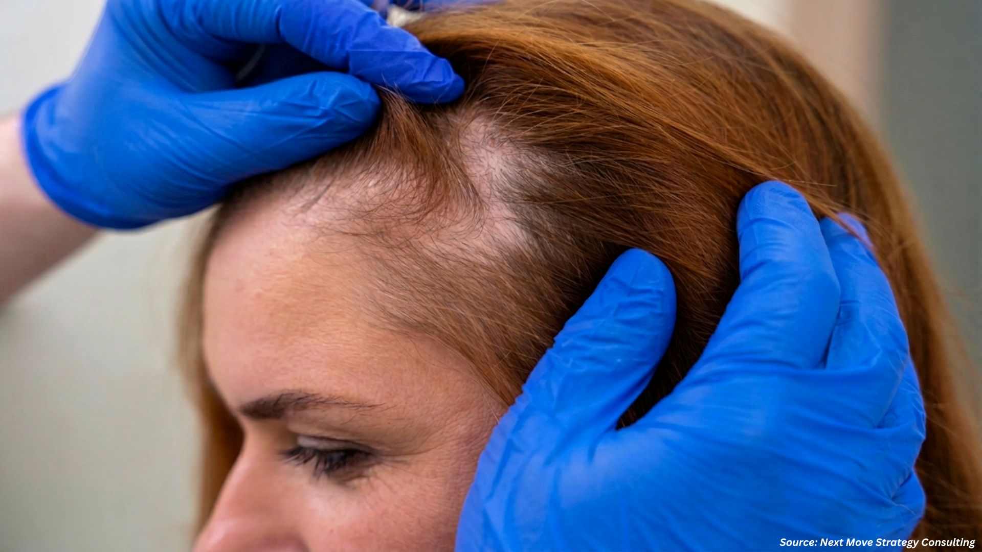 Why Alopecia Is Gaining More Attention in 2026?