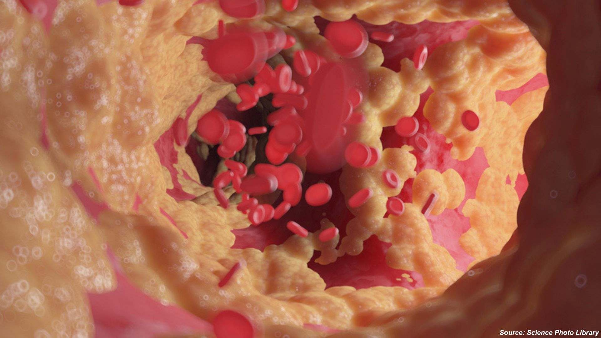 Base Editing: Precision Gene Therapy Enters the Clinical Era