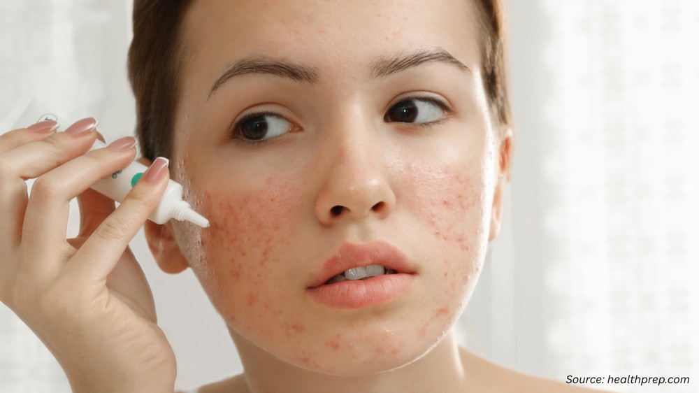 Revolutionizing Skincare: How The Professional Acn...