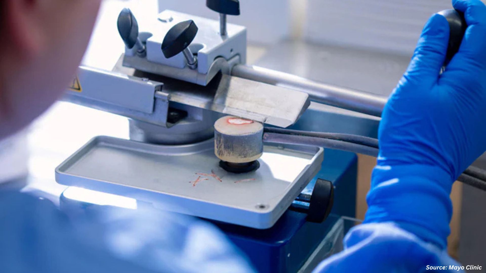 Lung Cancer Surgery: Precision, Outcomes & Integrated Innovation