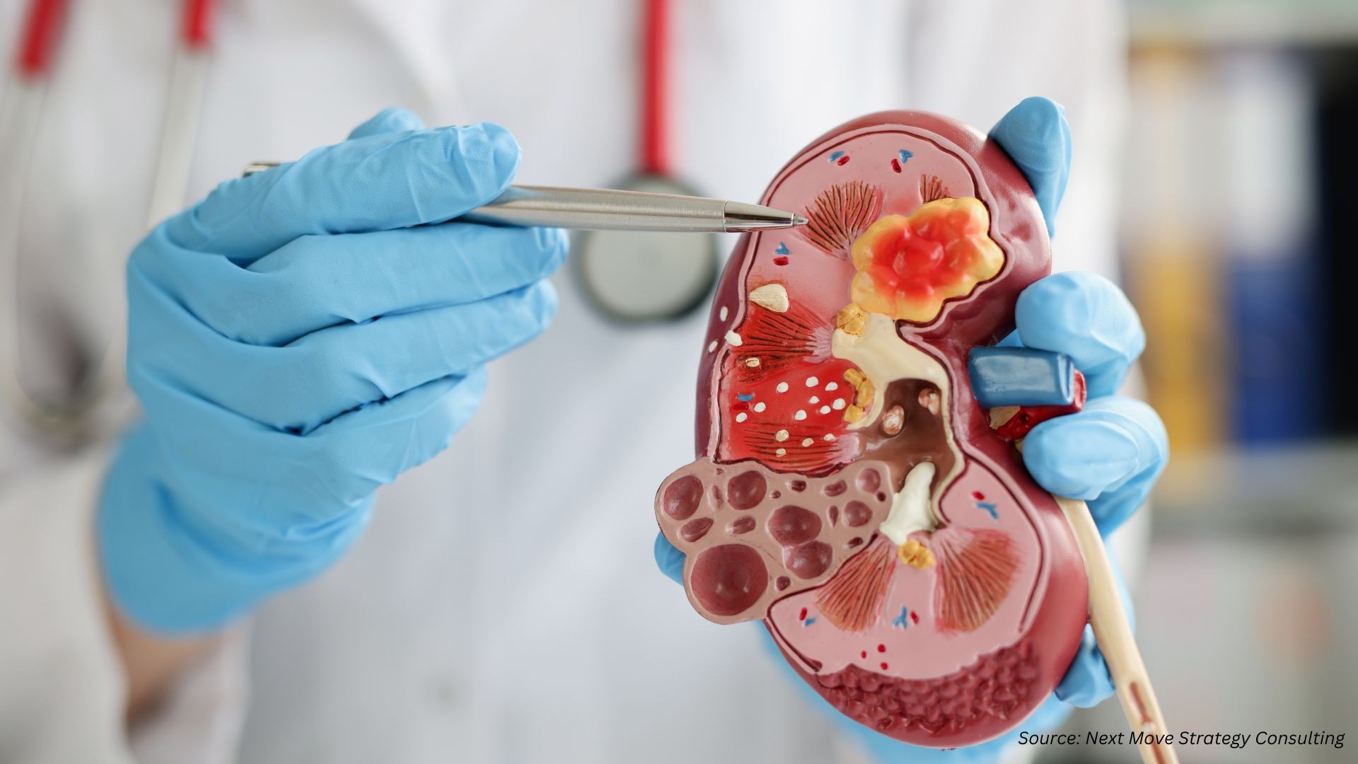 Advances in Kidney Stone Management for Better Outcomes