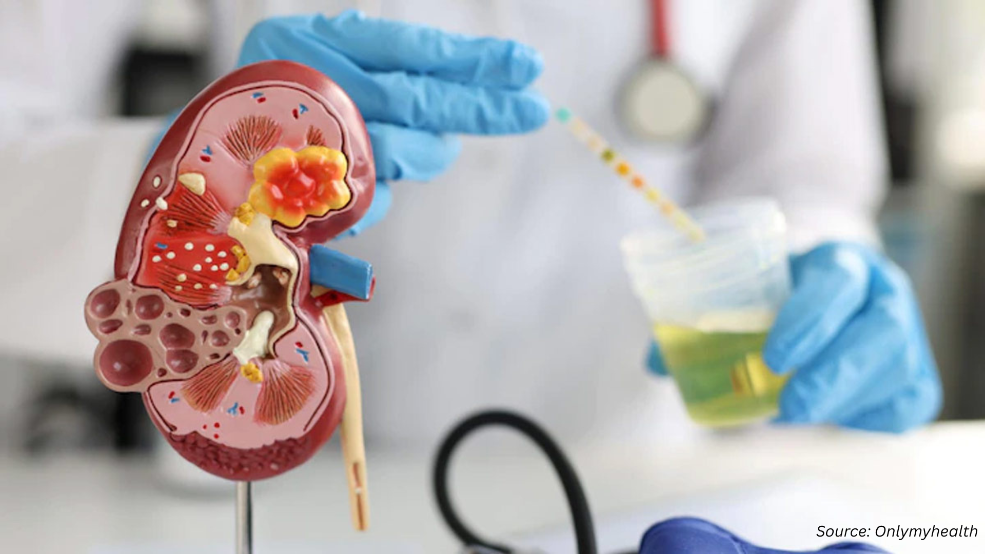 Kidney Stone Management Market Reaches New Heights: Technological Innovations Define 2024-2030 Landscape