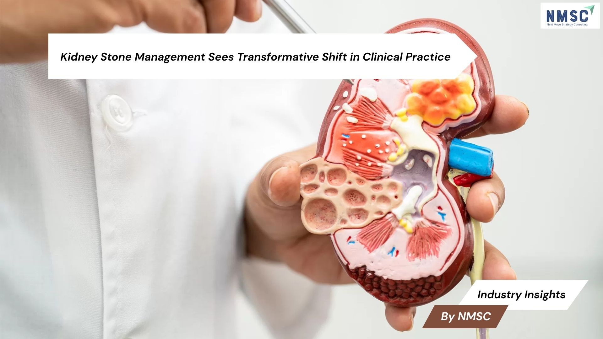 Kidney Stone Management Sees Transformative Shift in Clinical Practice