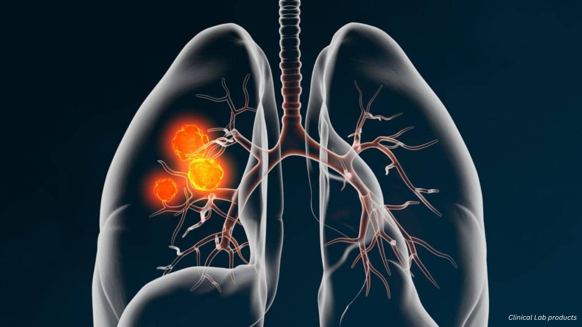 Advances in Lung Cancer Diagnostics 2025
