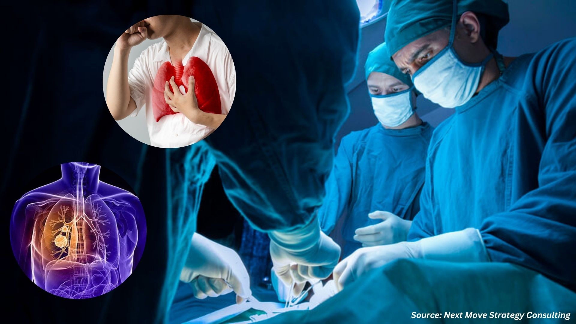 Lung Cancer Surgery Enters Evidence Driven Era
