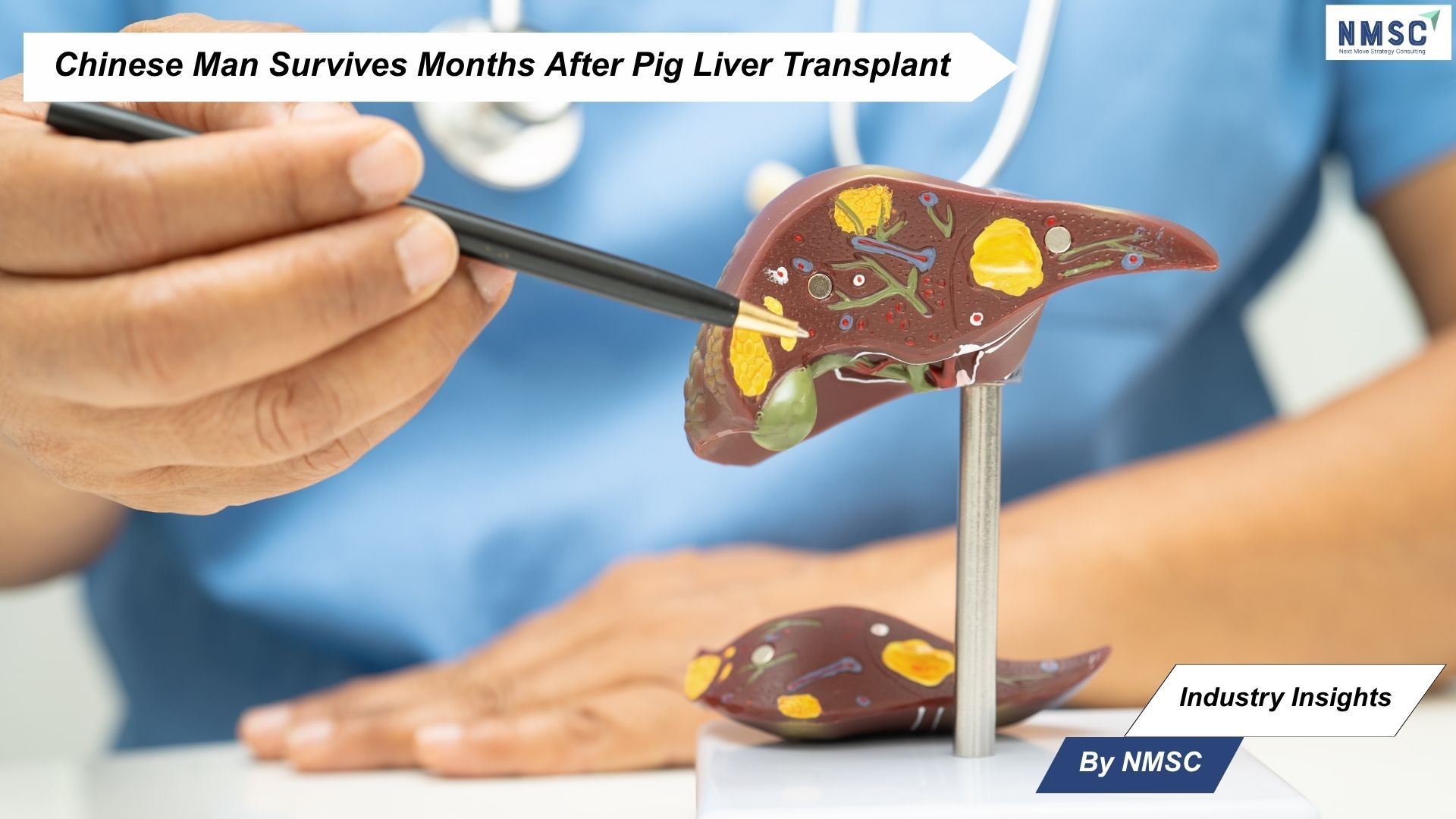 Chinese Man Survives Months After Pig Liver Transplant